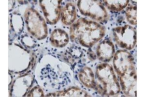 Immunohistochemical staining of paraffin-embedded Adenocarcinoma of Human endometrium tissue using anti-GAS7 mouse monoclonal antibody. (GAS7 Antikörper)