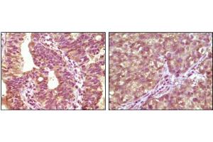 Immunohistochemical analysis of paraffin-embedded human bladder carcinoma tissue(left) and lung carcinoma tissue (right) showing cytoplasmic localization using BRAF mouse mAb with DAB staining. (BRAF Antikörper)