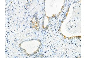 ABIN6262787 and ABIN6266575 at 1/100 staining human ovarian cancer by IHC-P.
