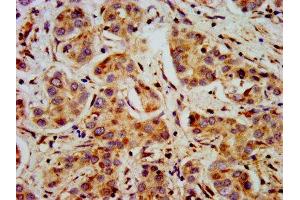 IHC image of ABIN7169467 diluted at 1:400 and staining in paraffin-embedded human liver cancer performed on a Leica BondTM system. (SHANK2 Antikörper  (AA 728-822))