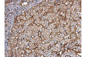 IHC-P Image Apolipoprotein E antibody detects Apolipoprotein E protein at secreted on human hepatoma by immunohistochemical analysis. (APOE Antikörper  (N-Term))