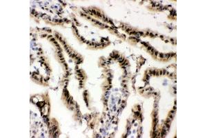 IHC analysis of EWSR1 using anti-EWSR1 antibody (ABIN3043825).