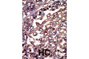 Formalin-fixed and paraffin-embedded human hepatocellular carcinoma tissue reacted with PRKAR1A polyclonal antibody  , which was peroxidase-conjugated to the secondary antibody, followed by AEC staining. (PRKAR1A Antikörper  (N-Term))