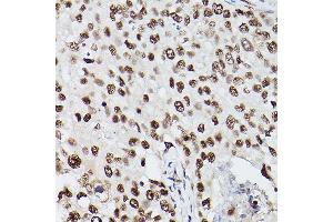 Immunohistochemistry of paraffin-embedded human breast cancer using PSME3 Rabbit pAb (ABIN6135015, ABIN6146357, ABIN6146358 and ABIN6216428) at dilution of 1:100 (40x lens). (PSME3 Antikörper  (C-Term))
