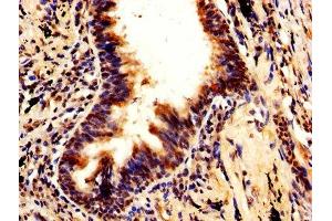 IHC image of ABIN7168493 diluted at 1:600 and staining in paraffin-embedded human lung cancer performed on a Leica BondTM system. (RUVBL1 Antikörper  (AA 101-400))