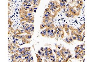 Immunohistochemistry analysis of paraffin-embedded human liver cancer using CD107b Polyclonal Antibody at dilution of 1:300. (LAMP2 Antikörper)
