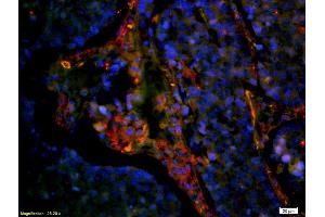 Formalin-fixed and paraffin embedded human lung carcinoma labeled with Anti-CD8 Polyclonal Antibody, Unconjugated (ABIN1385272) at 1:200 followed by secondary antibody was Goat Anti-Rabbit IgG, Cy3 conjugated used at 1:200 (CD8 Antikörper  (AA 51-150))