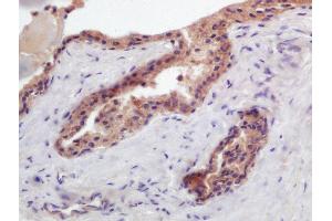 Formalin-fixed and paraffin embedded human prostate carcinoma labeled with Anti-PTGFR Polyclonal Antibody, Unconjugated (ABIN2178742) at 1:200 followed by conjugation to the secondary antibody and DAB staining (PTGFR Antikörper  (AA 121-220))