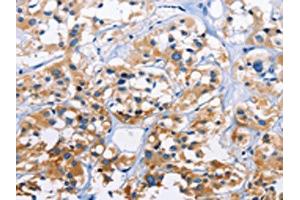 The image on the left is immunohistochemistry of paraffin-embedded Human thyroid cancer tissue using ABIN7128760(CAPZA3 Antibody) at dilution 1/70, on the right is treated with fusion protein. (CAPZA3 Antikörper)