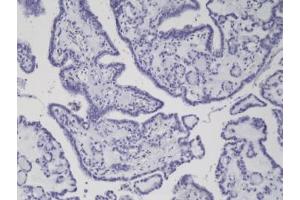 IHC staining of formalin fixed and paraffin embedded thyroid carcinoma tissue with recombinant BRAF V600E antibody. (Rekombinanter BRAF Antikörper  (Val600Glu-Mutant))