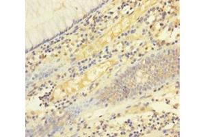Immunohistochemistry of paraffin-embedded human colon cancer using ABIN7173813 at dilution of 1:100 (FASL Antikörper  (AA 103-281))