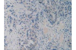 IHC-P analysis of Human Breast Cancer Tissue, with DAB staining. (PACAP Antikörper  (AA 17-176))