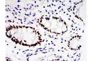 Immunohistochemical analysis of paraffin-embedded colon cancer tissues (ETV4 Antikörper  (Internal Region))