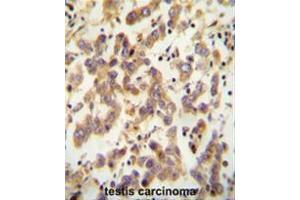 CT173 antibody (Center) immunohistochemistry analysis in formalin fixed and paraffin embedded human testis carcinoma followed by peroxidase conjugation of the secondary antibody and DAB staining.