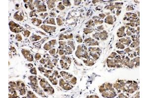 IHC testing of human pancreatic cancer tissue with Alpha Amylase antibody at 0. (Alpha-amylase 1 Antikörper  (AA 20-50))