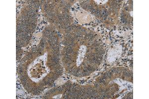 Immunohistochemistry of Human colon cancer using HSD3B1 Polyclonal Antibody at dilution of 1:40