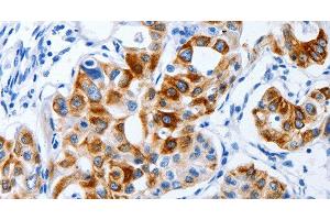 Immunohistochemistry of paraffin-embedded Human lung cancer using BPIFB3 Polyclonal Antibody at dilution of 1:120 (BPIFB3 Antikörper)