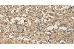 Immunohistochemistry of paraffin-embedded Human thyroid cancer using ALDH8A1 Polyclonal Antibody at dilution of 1:30 (ALDH8A1 Antikörper)