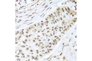 Immunohistochemistry of paraffin-embedded human lung cancer using PGR antibody.