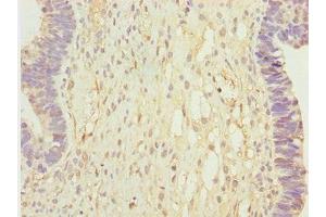 Immunohistochemistry of paraffin-embedded human ovarian cancer using ABIN7146349 at dilution of 1:100 (CALCOCO2 Antikörper  (AA 137-446))