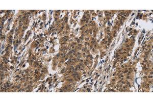 Immunohistochemistry of paraffin-embedded Human gasrtic cancer tissue using IL12RB2 Polyclonal Antibody at dilution 1:40 (IL12RB2 Antikörper)