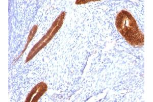 Formalin-fixed, paraffin-embedded human Endometrial Carcinoma stained with Cytokeratin 7 Mouse Monoclonal Antibody (KRT7/760). (Cytokeratin 7 Antikörper)