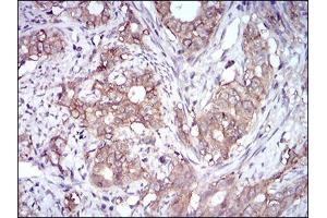 Immunohistochemical analysis of paraffin-embedded cervical cancer tissues using EPCAM mouse mAb with DAB staining.