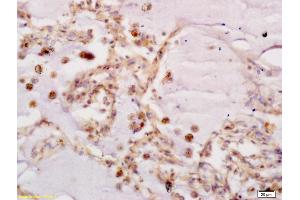 Formalin-fixed and paraffin embedded human lung carcinoma labeled with Anti-Frizzled 7/FZE3 Polyclonal Antibody, Unconjugated (ABIN710051) at 1:200, followed by conjugation to the secondary antibody and DAB staining (FZD7 Antikörper  (AA 501-574))