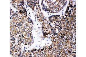 IHC-P: ABCB6 antibody testing of human breast cancer tissue (ABCB6 Antikörper  (C-Term))