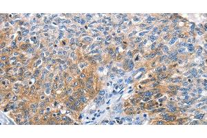Immunohistochemistry of paraffin-embedded Human ovarian cancer tissue using CGB Polyclonal Antibody at dilution 1:60 (CGB Antikörper)