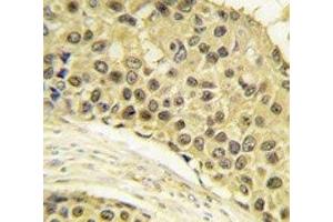 IHC analysis of FFPE human breast carcinoma tissue stained with Cyclin A2 antibody (Cyclin A Antikörper  (AA 358-389))