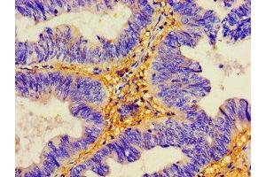 Immunohistochemistry of paraffin-embedded human colon cancer using ABIN7149779 at dilution of 1:100
