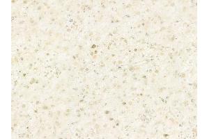 ABIN6264227 and ABIN6278772 at 1/100 staining human astrocytoma by IHC-P. (PINX1 Antikörper  (Internal Region))