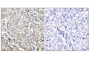 Immunohistochemical analysis of paraffin-embedded human breast carcinoma tissue, using NF-κB p65 (Phospho-Ser529) antibody (E011217). (NF-kB p65 Antikörper  (pSer529))