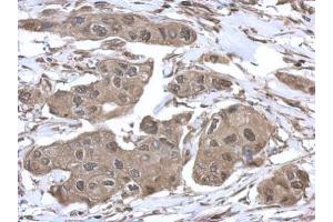 IHC-P Image Immunohistochemical analysis of paraffin-embedded human breast cancer, using VCP, antibody at 1:500 dilution. (VCP Antikörper  (C-Term))