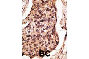 Formalin-fixed and paraffin-embedded human cancer tissue reacted with the SIGLEC8 polyclonal antibody  , which was peroxidase-conjugated to the secondary antibody, followed by DAB staining. (SIGLEC8 Antikörper  (C-Term))