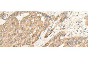 Immunohistochemistry of paraffin-embedded Human liver cancer tissue using IMPA1 Polyclonal Antibody at dilution of 1:25(x200)