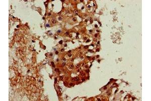 Immunohistochemistry of paraffin-embedded human breast cancer using ABIN7161445 at dilution of 1:100 (Neuroserpin Antikörper  (AA 191-240))