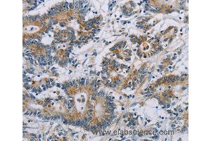 Immunohistochemistry of Human colon cancer using CSNK1E Polyclonal Antibody at dilution of 1:60