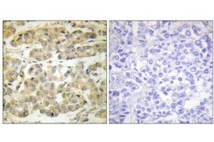 Immunohistochemical analysis of paraffin-embedded human breast carcinoma tissue, using 14-3-3 zeta (phospho-Ser58) antibody. (14-3-3 zeta Antikörper  (pSer58))