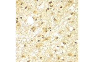 Immunohistochemistry of paraffin-embedded human brain cancer using TBL1XR1 antibody at dilution of 1:100 (x400 lens). (TBL1XR1 Antikörper)