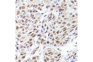 Immunohistochemistry of paraffin-embedded human esophageal cancer using SEC14L2 Rabbit pAb (ABIN6132639, ABIN6147484, ABIN6147485 and ABIN6214889) at dilution of 1:200 (40x lens). (SEC14L2 Antikörper  (AA 60-270))