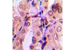 Immunohistochemical analysis of SMAD2 (pS465) staining in human breast cancer formalin fixed paraffin embedded tissue section. (SMAD2 Antikörper  (C-Term, pSer465))