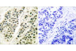Peptide - +Immunohistochemical analysis of paraffin-embedded human breast carcinoma tissue using DNA Polymerase β antibody (#C0173). (POLB Antikörper)