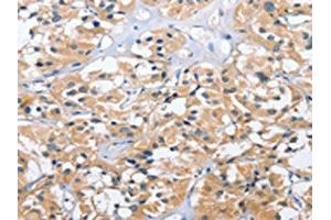 The image on the left is immunohistochemistry of paraffin-embedded Human thyroid cancer tissue using ABIN7131541(UGCG Antibody) at dilution 1/40, on the right is treated with fusion protein. (UGCG Antikörper)