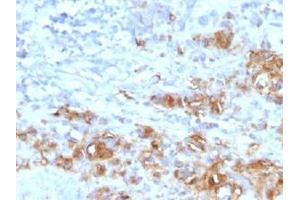 Immunohistochemical staining (Formalin-fixed paraffin-embedded sections) of human gastric carcinoma with CA19-9 recombinant monoclonal antibody, clone CA19. (Rekombinanter CA 19-9 Antikörper)