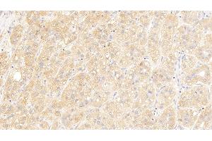 Detection of IGSF1 in Human Liver cancer Tissue using Polyclonal Antibody to Immunoglobulin superfamily, member 1 (IGSF1) (IGSF1 Antikörper  (AA 1008-1227))