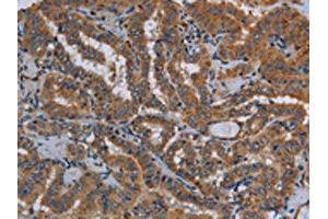 The image on the left is immunohistochemistry of paraffin-embedded Human thyroid cancer tissue using ABIN7130015(KLK13 Antibody) at dilution 1/20, on the right is treated with fusion protein. (Kallikrein 13 Antikörper)