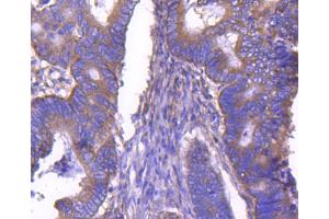 Paraformaldehyde-fixed, paraffin embedded human colon cancer, Antigen retrieval by boiling in sodium citrate buffer (pH6) for 15min, Block endogenous peroxidase by 3% hydrogen peroxide for 30 minutes, Blocking buffer at 37°C for 20min, Antibody incubation with ARF1 (1D4) Monoclonal Antibody  at 1:50 overnight at 4°C, followed by a conjugated secondary and DAB staining. (ARF1 Antikörper)