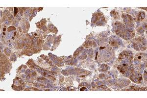 ABIN6273772 at 1/100 staining Human liver cancer tissue by IHC-P. (RIPK1 Antikörper  (Internal Region))